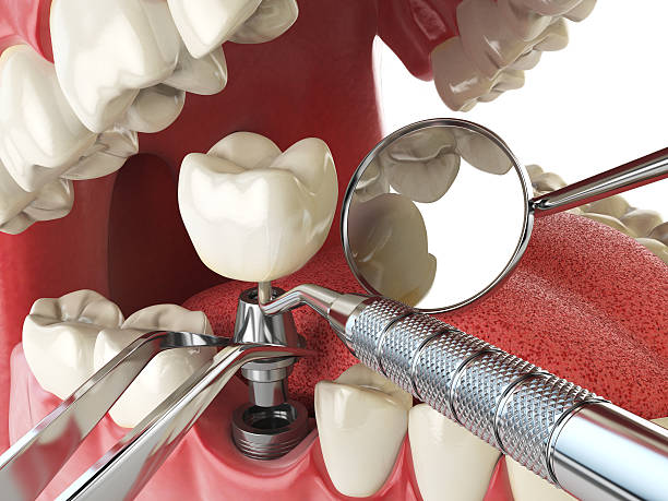 Best Emergency Root Canal Therapy in Montclair State University, NJ